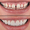 Вініри зубні Perfect Smile Veneers замінні White (kz059-hbr)