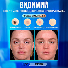 Електрокоагулятор плазмовий VLVEE Білий (VLV-5163)