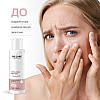 Отшелушуючий тонер для обличчя Exfoliating Face toner RE.CARE 150 мл