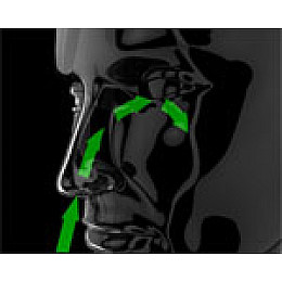 Лечение аллергического насморка Medisana Medinose BNS