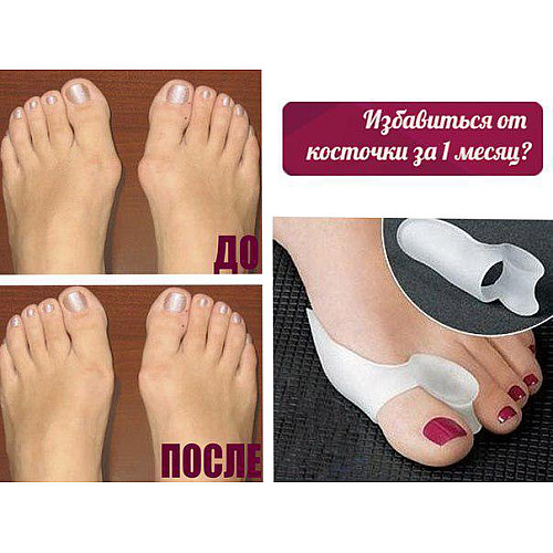 Лечебный фиксатор большого пальца Valgus Pro Medicus (Вальгус Про) - пара, для коррекции косточки